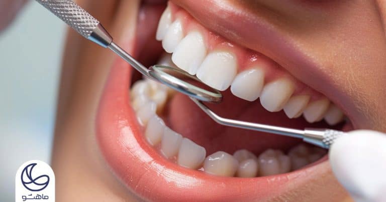طول عمر لمینت دندان چقدر است ؟