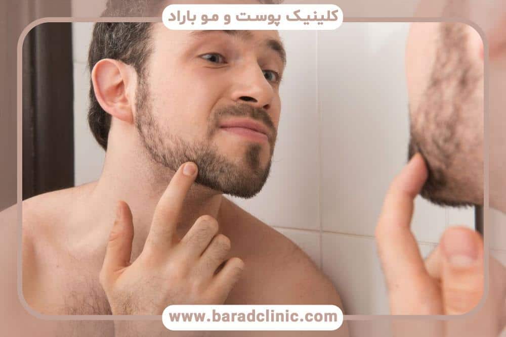 کاشت ریش