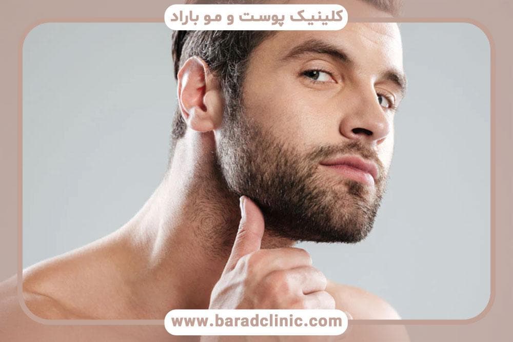 کاشت ریش