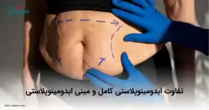 تفاوت ابدومینوپلاستی کامل و مینی ابدومینوپلاستی تفاوت ابدومینوپلاستی کامل و مینی ابدومینوپلاستی