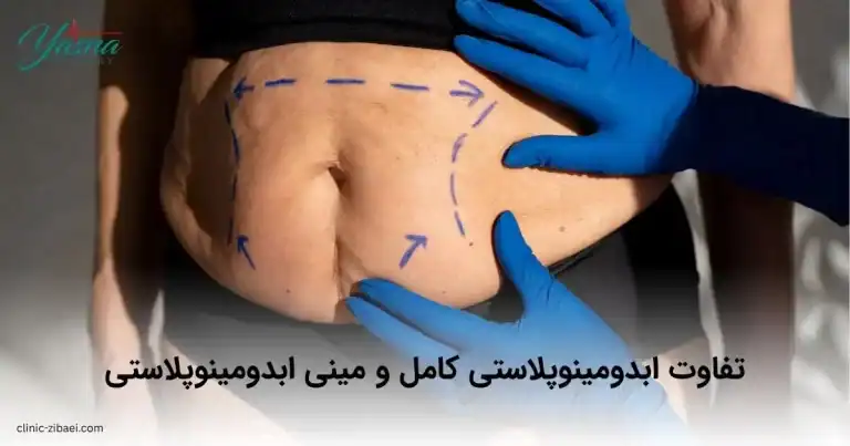 تفاوت ابدومینوپلاستی کامل و مینی ابدومینوپلاستی