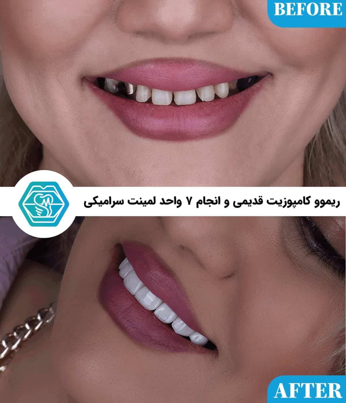 لمینت دندان برای چه افرادی مناسب است؟ ۸ نکته قبل از تصمیمگیری لمینت دندان برای چه افرادی مناسب است؟ ۸ نکته قبل از تصمیمگیری