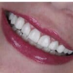 لمینت دندان برای چه افرادی مناسب است؟ ۸ نکته قبل از تصمیم‌گیری