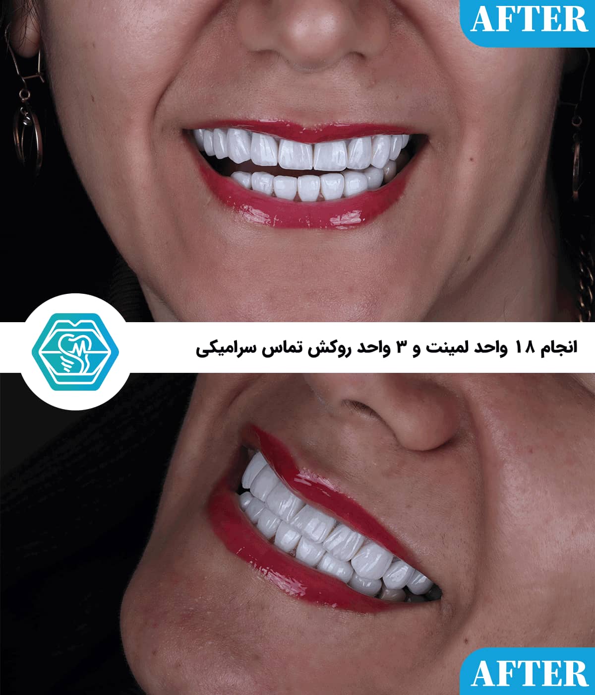 لمینت دندان برای چه افرادی مناسب است؟ ۸ نکته قبل از تصمیمگیری لمینت دندان برای چه افرادی مناسب است؟ ۸ نکته قبل از تصمیمگیری