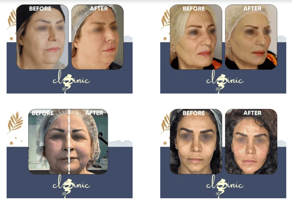 نمونه کار اندولیفت