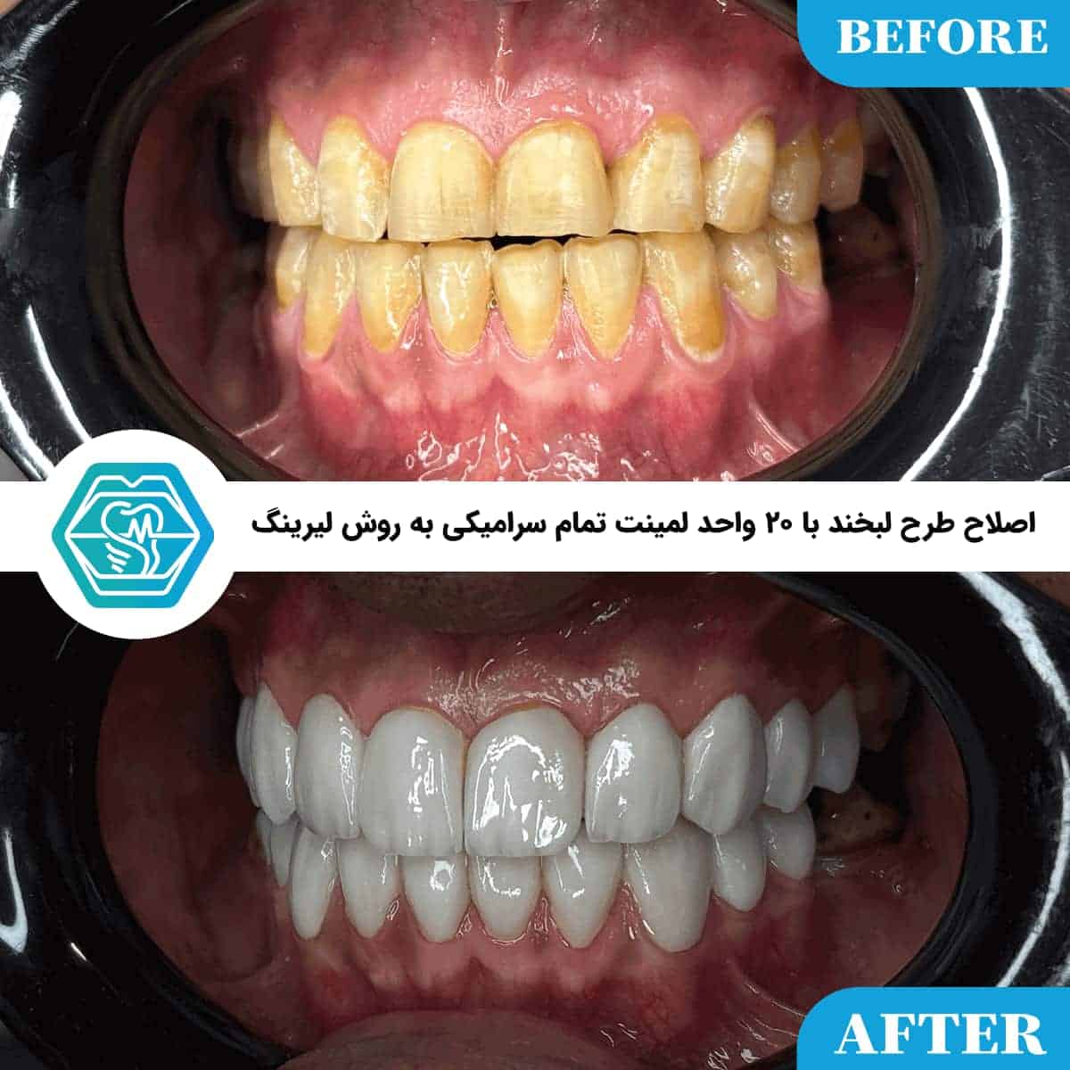 لمینت دندان برای چه افرادی مناسب است؟ ۸ نکته قبل از تصمیمگیری لمینت دندان برای چه افرادی مناسب است؟ ۸ نکته قبل از تصمیمگیری