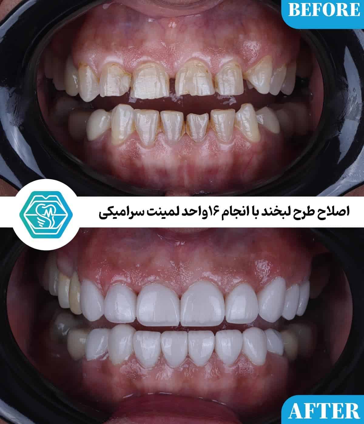 لمینت دندان برای چه افرادی مناسب است؟ ۸ نکته قبل از تصمیمگیری لمینت دندان برای چه افرادی مناسب است؟ ۸ نکته قبل از تصمیمگیری
