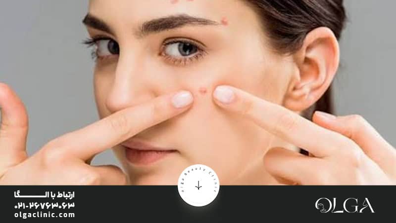 از بین بردن جای جوش در چند ثانیه