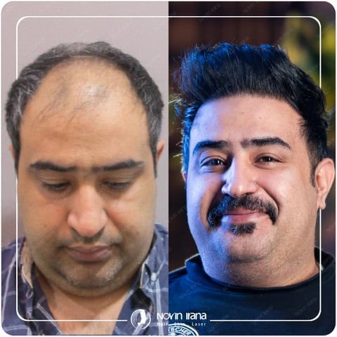 چه کسانی نباید کاشت مو انجام دهند؟