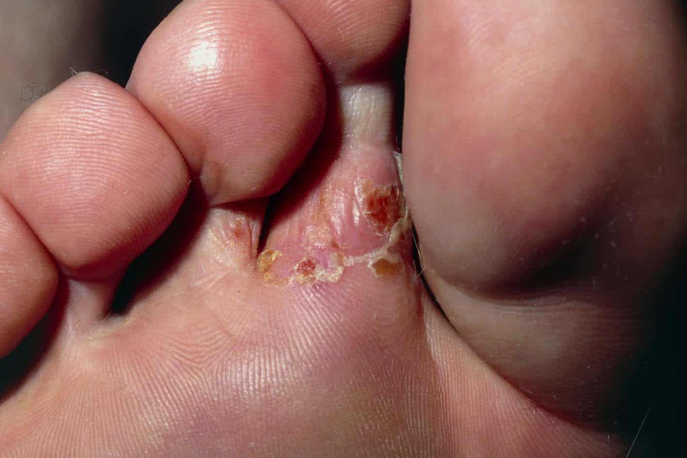 بیماری پای ورزشکار Athlete's foot